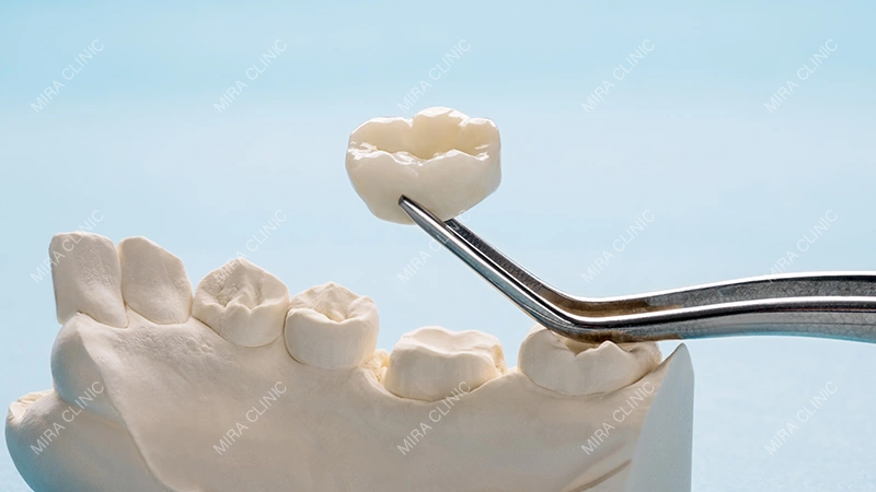 What Is a Dental Crown?